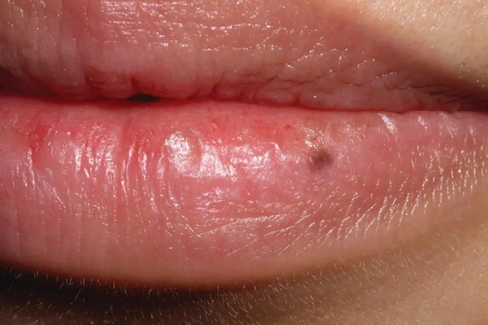Multifocal Pigmentation