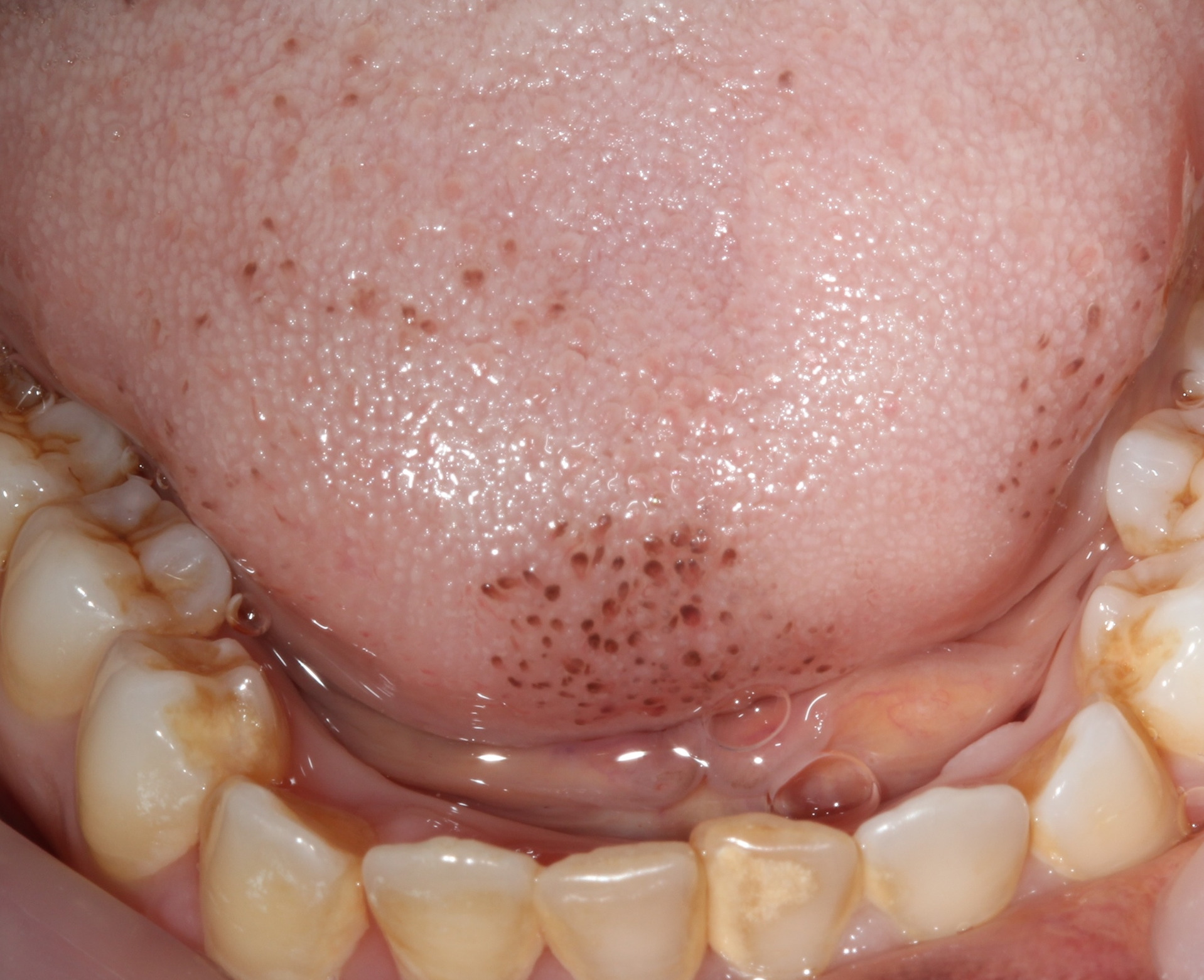Multifocal Pigmentation