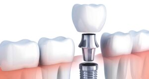 Dental Implants in Abu Dhabi