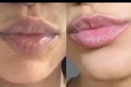 Smoker’s Lips Treatment in Abu Dhabi