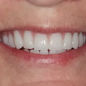 Teeth Dentures in Abu Dhabi