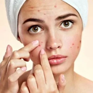 acne treatment in Abu Dhabi