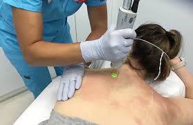 laser pigmentation treatment