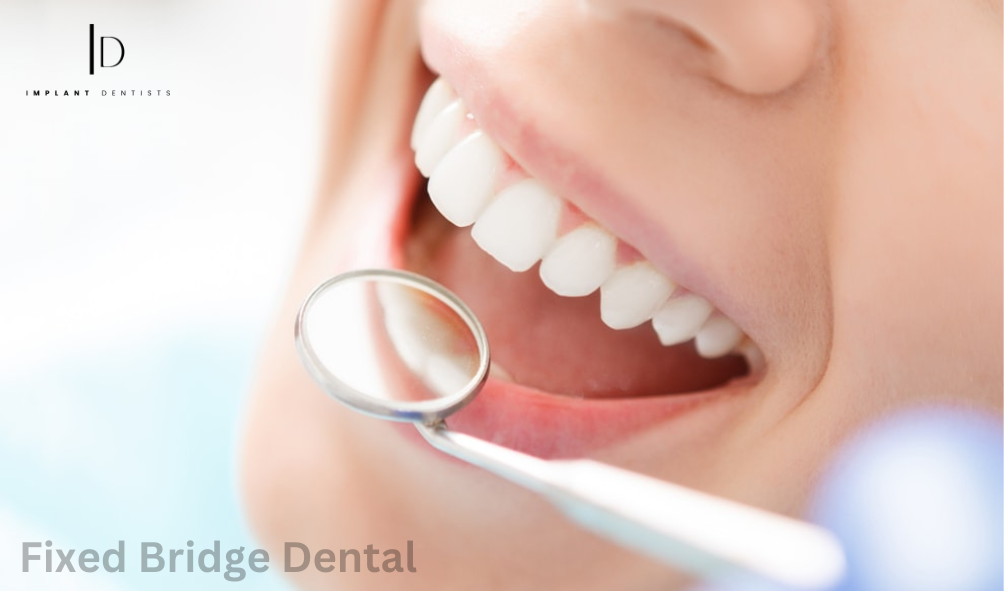 Fixed Bridge Dental - What You Need to Know - Check Now