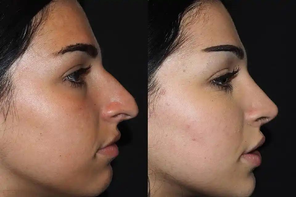 Dubai's Rhinoplasty: Costs, Recovery, and Transformative Results