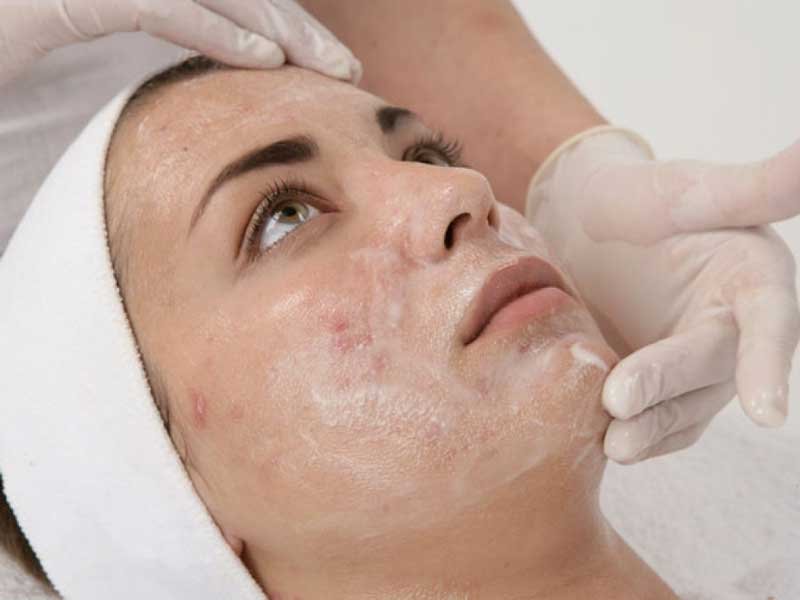 Achieve Radiant Skin with Chemical Peel Treatments in Pakistan