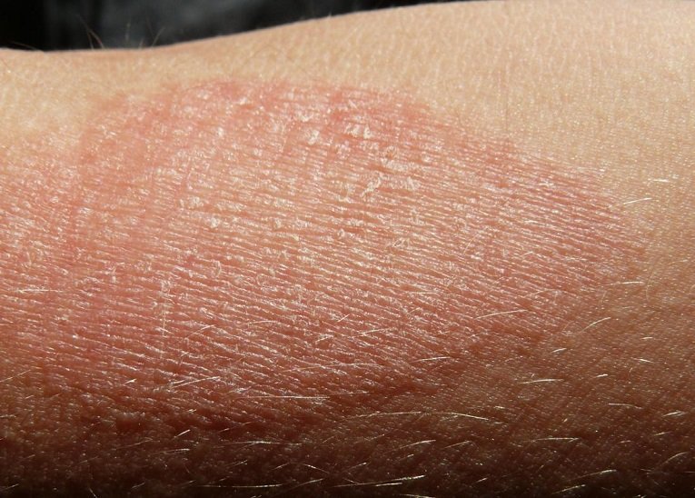 How to cure itching flaky dry skin