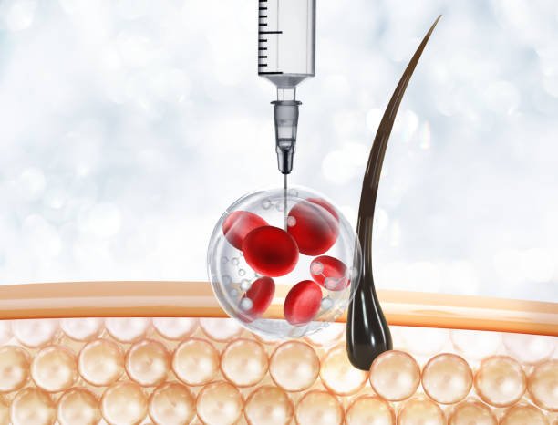 The Complete Guide to PRP Hair Treatment Pricing in Abu Dhabi