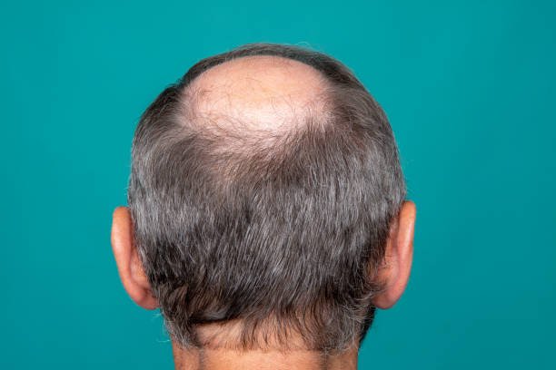 FUE Hair Transplant in Abu Dhabi: Achieve Natural-Looking Hair