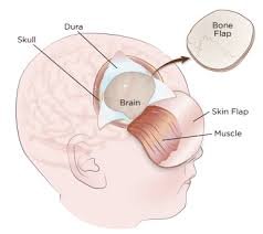 Craniotomy Surgery for Treatment of Brain Tumour in India